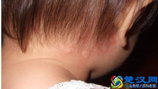 荨麻疹爆发 吃太多成主因 荨麻疹反复发作怎么办？