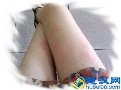 荨麻疹爆发 吃太多成主因 荨麻疹反复发作怎么办？