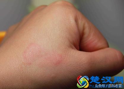 荨麻疹爆发 吃太多成主因 荨麻疹反复发作怎么办？