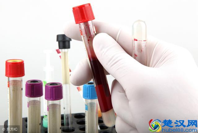 胆红素偏高，就是肝受损了？专家：还有这些原因不能小视