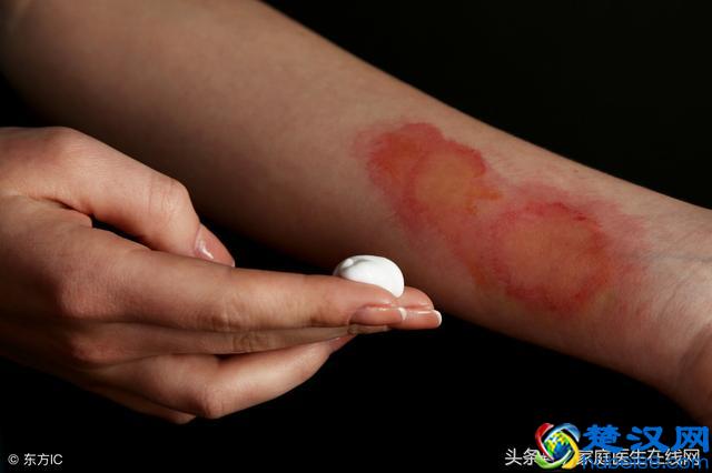被开水烫伤该怎么办？妈妈用一急救方法，连医生都点赞，建议收藏