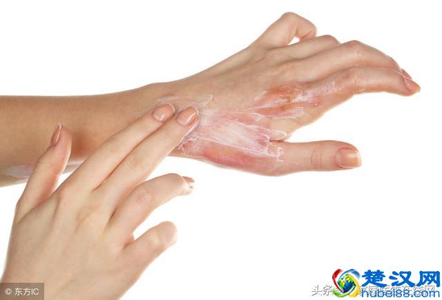 被开水烫伤该怎么办？妈妈用一急救方法，连医生都点赞，建议收藏