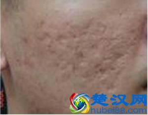 脸上的痘痘和印痘坑去除方法