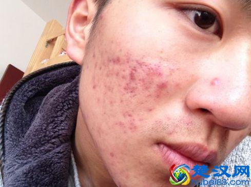 脸上的痘痘和印痘坑去除方法