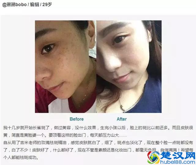 色斑三周就消失！我试了78种祛斑方法，最有效的不到就这1种！