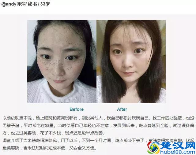 色斑三周就消失！我试了78种祛斑方法，最有效的不到就这1种！