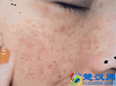 色斑三周就消失！我试了78种祛斑方法，最有效的不到就这1种！