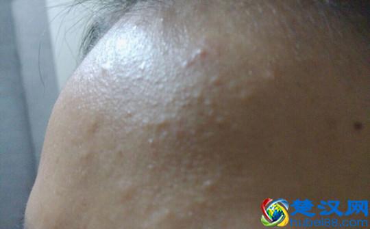 脸上长这种小疙瘩可能是闭口粉刺 简单几招帮你轻松祛除