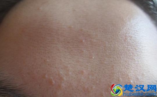 脸上长这种小疙瘩可能是闭口粉刺 简单几招帮你轻松祛除