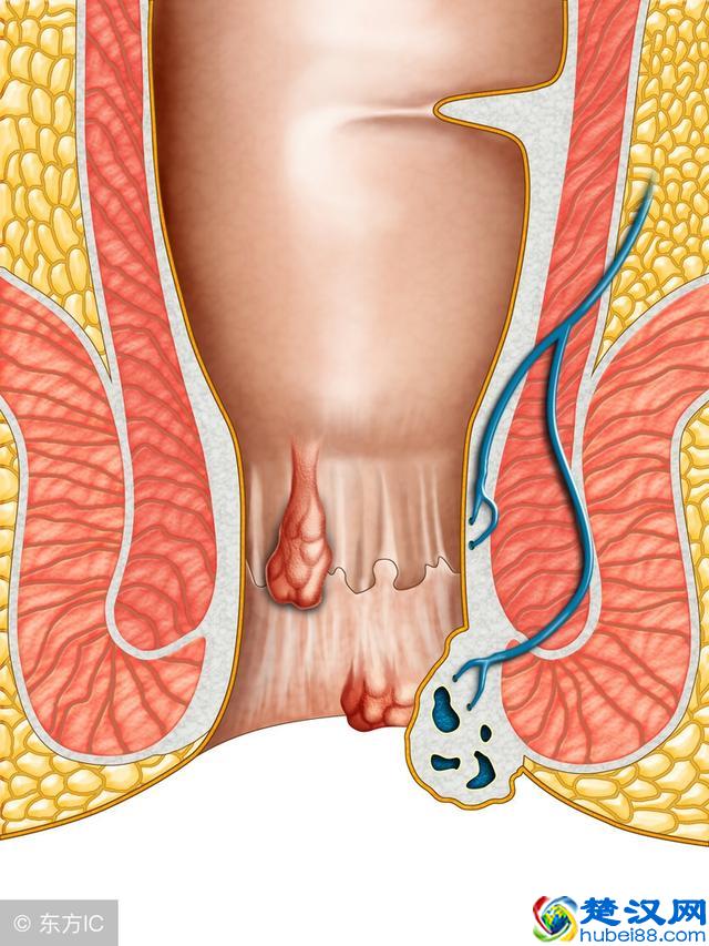 得痔疮的原因是什么?长痔疮千万不能吃什么?