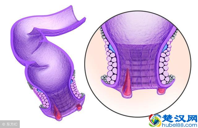 得痔疮的原因是什么?长痔疮千万不能吃什么?