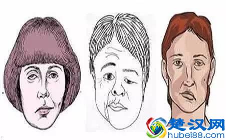 左眼跳是什么预兆，左眼跳小心是这4种疾病