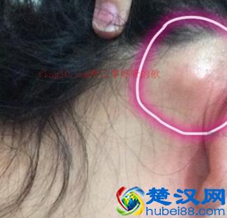 耳朵后面长了个硬包怎么办如何医治