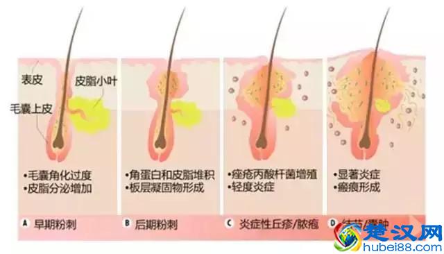 鼻孔两侧毛孔大怎么办？长痘、痘坑怎么办？冻干粉好用吗？