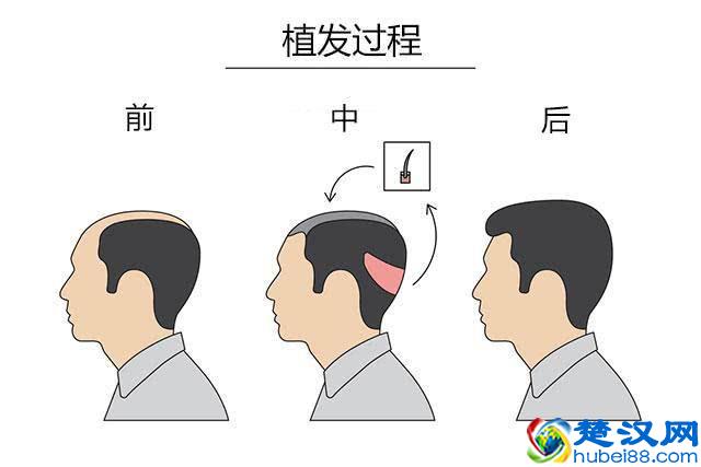 告别脱发、掉发、头发稀疏，做回头发茂密的少年！就用这一招！