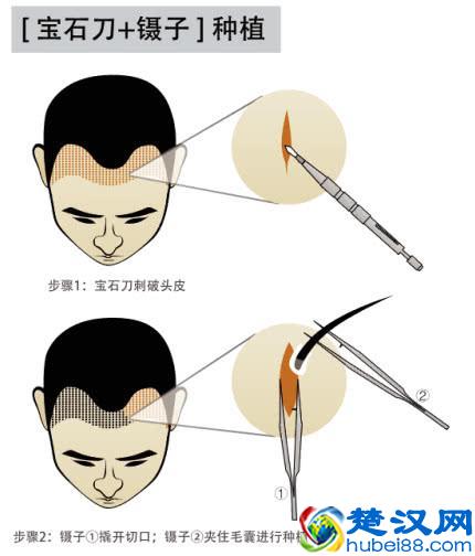 告别脱发、掉发、头发稀疏，做回头发茂密的少年！就用这一招！