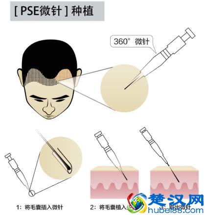 告别脱发、掉发、头发稀疏，做回头发茂密的少年！就用这一招！