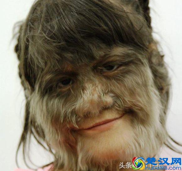 11岁女孩，脸上长满长毛，被称做“狼女”