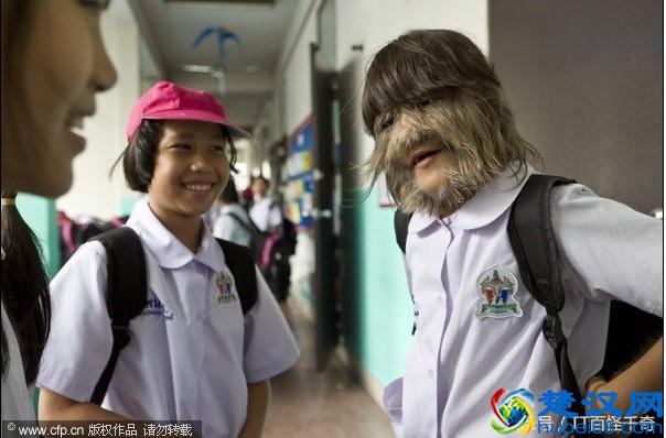 11岁女孩，脸上长满长毛，被称做“狼女”