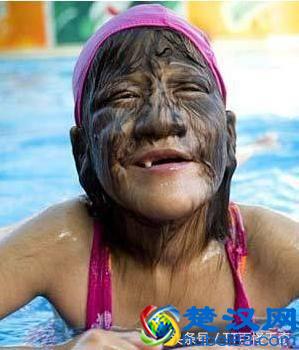 11岁女孩，脸上长满长毛，被称做“狼女”