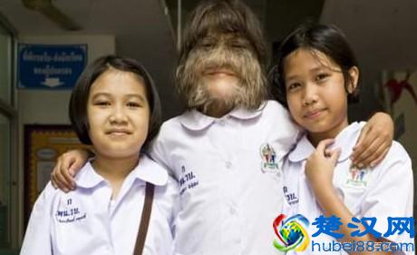 11岁女孩，脸上长满长毛，被称做“狼女”