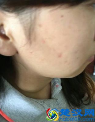 什么祛痘产品效果好,去青春痘的最快方法!