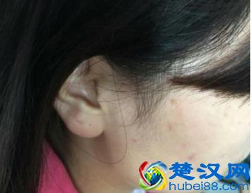 什么祛痘产品效果好,去青春痘的最快方法!