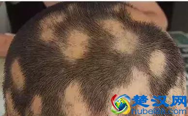 "鬼剃头"究竟是怎么回事？如何抓住这个"鬼"？答案都在这