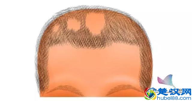 "鬼剃头"究竟是怎么回事？如何抓住这个"鬼"？答案都在这