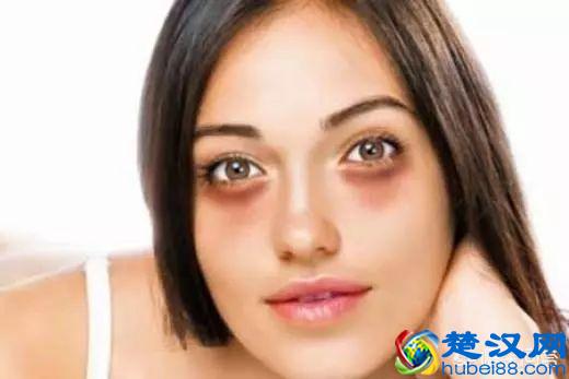 什么原因导致的黑眼圈？