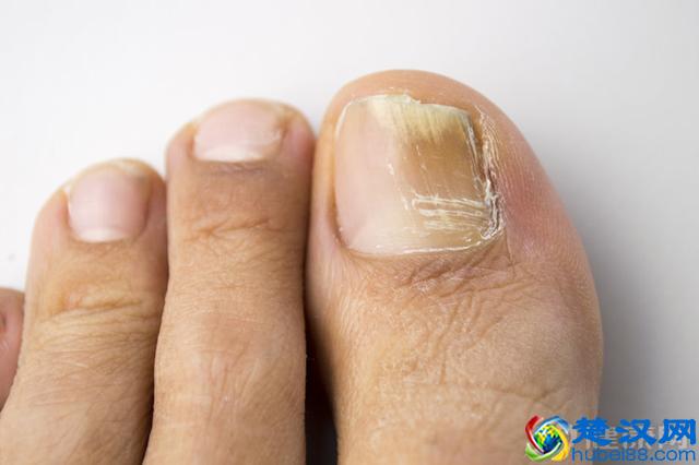 得了灰指甲怎么治？只需坚持一个方法，“连根拔起”不复发