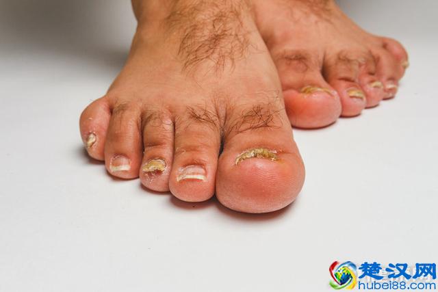 得了灰指甲怎么治？只需坚持一个方法，“连根拔起”不复发