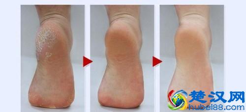 脚后跟干裂，有角质化硬皮怎么办？