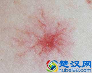 皮肤上出现这些红血丝，形似蜘蛛，这是为啥呢？