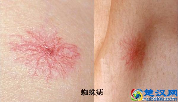 皮肤上出现这些红血丝，形似蜘蛛，这是为啥呢？