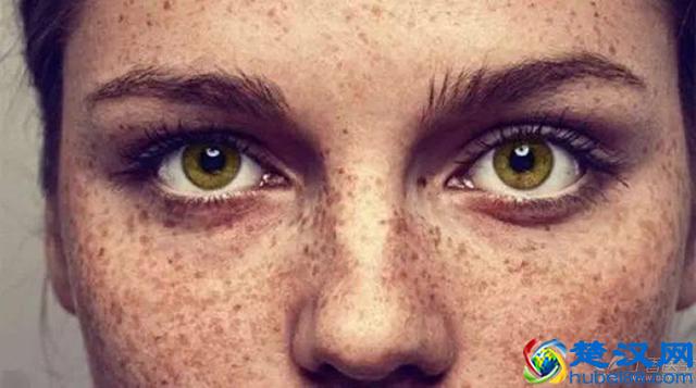 脸上有了斑，该怎么消除？不同的斑点有不同办法