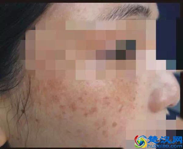脸上有了斑，该怎么消除？不同的斑点有不同办法