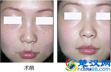 有没有什么方法可以彻底祛除雀斑？