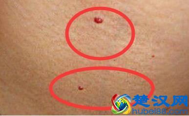 身上出现这种“小红点”，千万别忽视，可能是肝在向你求救！