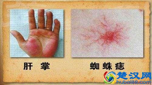 身上出现这种“小红点”，千万别忽视，可能是肝在向你求救！