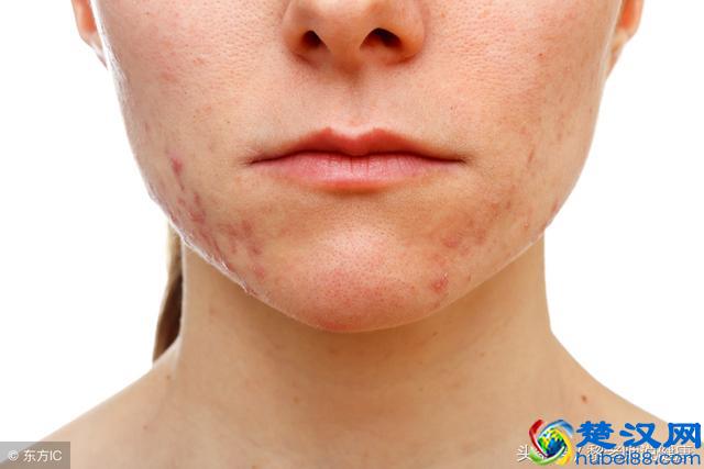 “祛痘神器”硫磺皂，你还在用吗？这3个坏处，你应该要知道！