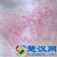 皮肤出现红血丝的原因是什么？怎么护理？
