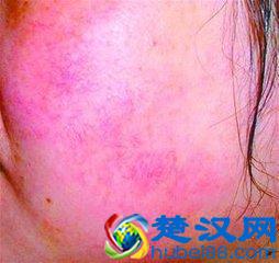 皮肤出现红血丝的原因是什么？怎么护理？
