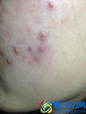 皮肤出现红血丝的原因是什么？怎么护理？