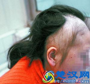 铊——一种对所有生物均有剧毒的化学元素