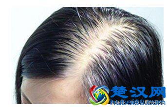 女性头发稀少怎么办