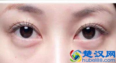 如何去眼袋和皱纹？