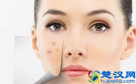 青春痘留下的瘢痕疙瘩能不能完全修复