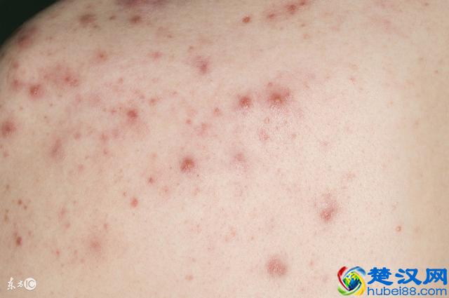 这5种除螨方法，每做到一样螨虫就远你一分！