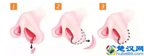 鼻翼缩小，让你的五官立起来